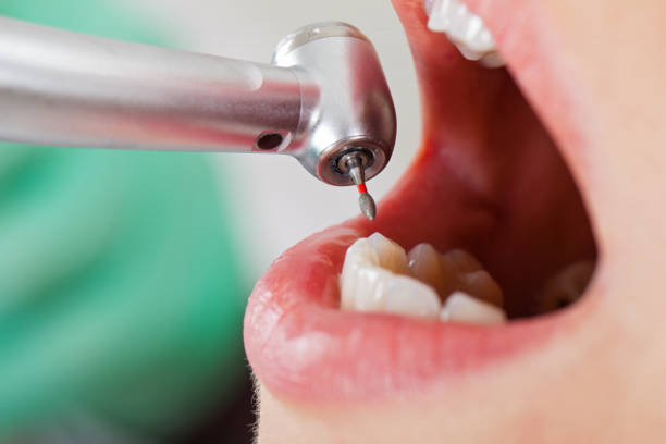 Best Emergency Tooth Extraction in Evergreen, MT